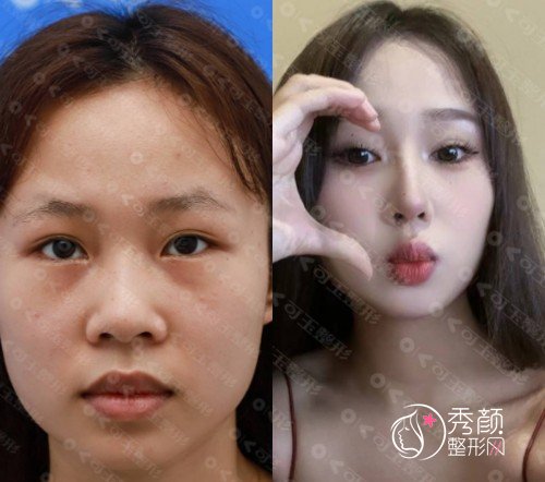 广州隆鼻郭栋医生怎么样，口碑如何？附隆鼻真实案例