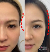 广州自体脂肪丰面