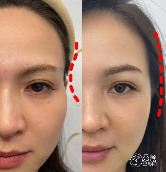 广州自体脂肪丰面颊医生排名：周滔、冯传波、王世虎等医生实力上榜