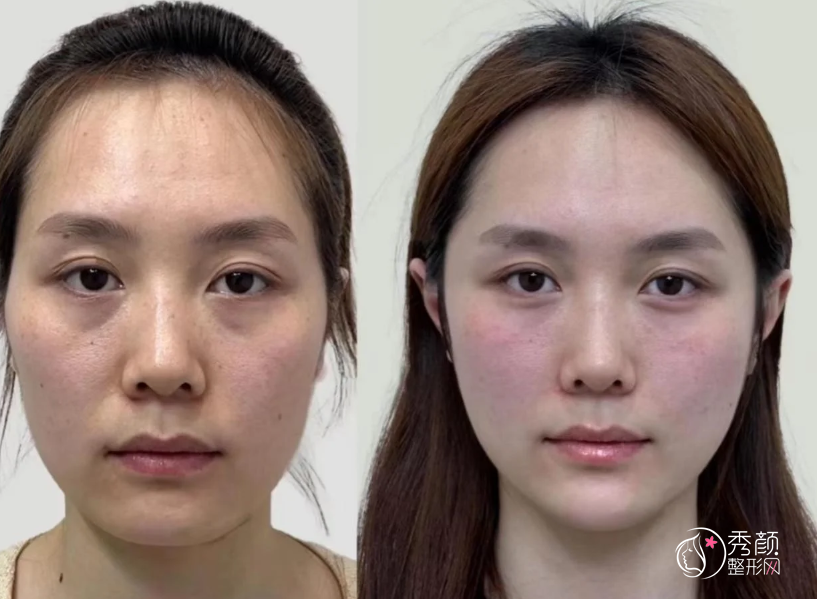 南京自体脂肪丰面颊医生排名：黄名斗、张荣明、李理等医生上榜