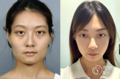 深圳颧骨内推医生