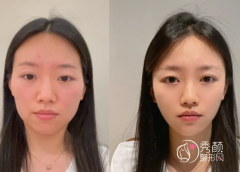 广州颧骨内推医生