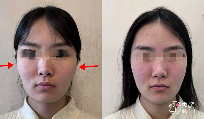 武汉颧骨内推医生排名：付国友、王介聪、周海孝等医生实力上榜