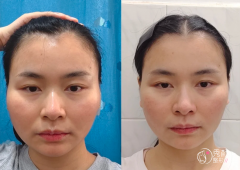 南京颧骨内推医生排名：吴国平、谭谦、李俊等医生实力上榜