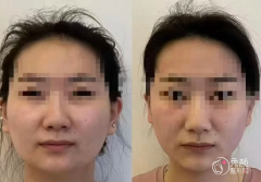 青岛颧骨内推医生排名：冷向锋、王竞鹏、袁荣涛等医生实力上榜