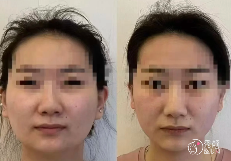 青岛颧骨内推医生排名：冷向锋、王竞鹏、袁荣涛等医生实力上榜