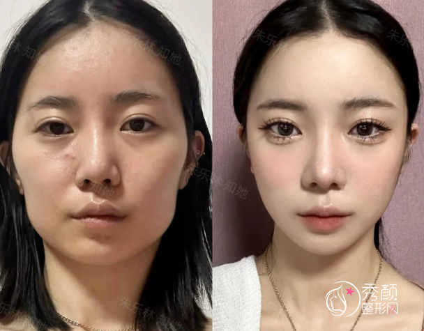 长沙颧骨内推医生排名：王先成、谭骛远朱轶等医生实力上榜