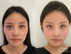 成都颧骨内推医生