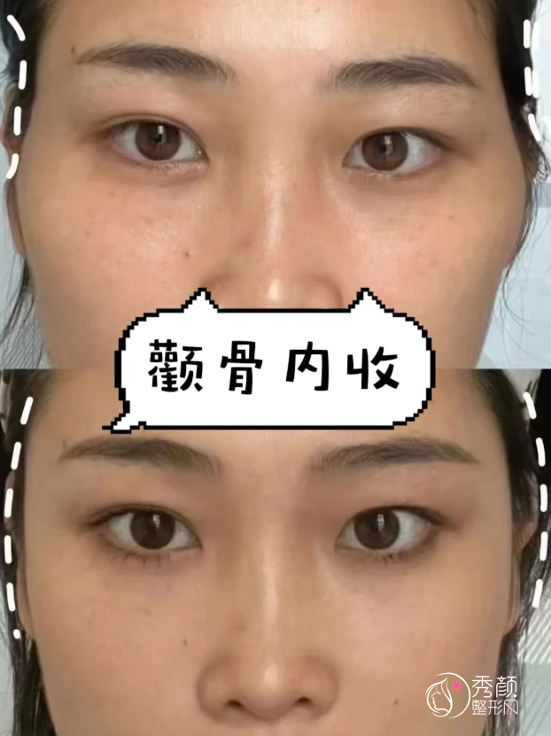 北京颧骨内推医生排名：解芳、黄大勇、张笑天等医生实力上榜