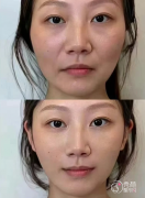 重庆颧骨内推医生