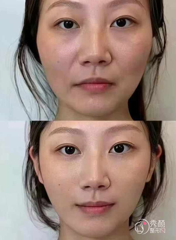 重庆颧骨内推医生排名：肖林、单磊、潘宝华等医生实力上榜