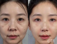 北京埋线提升医生