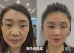 青岛埋线提升医生排名：胡晓莺、张维娜、唐春香等医生实力上榜