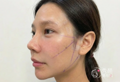 武汉埋线提升医生