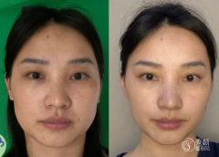 深圳埋线提升医生