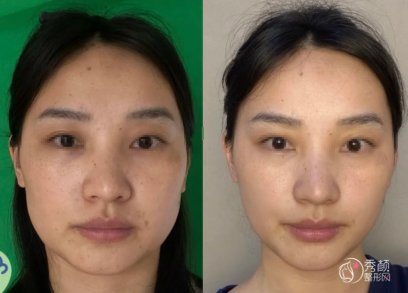 深圳埋线提升医生排名：胡刚、赵宁、姚成红等医生实力上榜