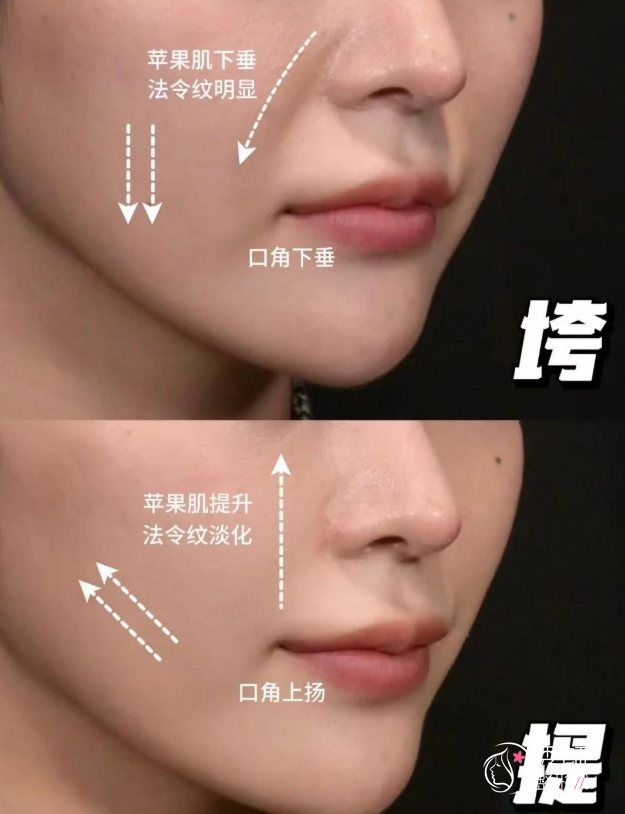 广州埋线提升医生排名：韦瑞莲、孙中生、玄峰等医生实力上榜