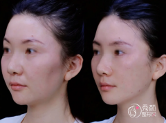 南京埋线提升医生