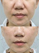 杭州埋线提升医生