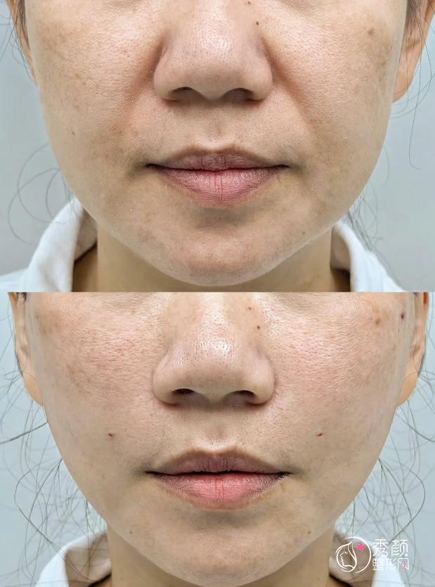 杭州埋线提升医生排名：许凤芝、朱斌堂、陈文才等医生实力上榜