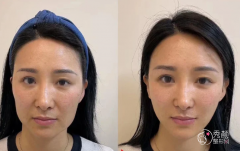 成都埋线提升医生排名：李建钢、卢元刚、刘黎明等医生实力上榜