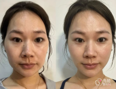 上海埋线提升医生排名：蔡跃波、杨娴娴、王晓阳等医生实力上榜