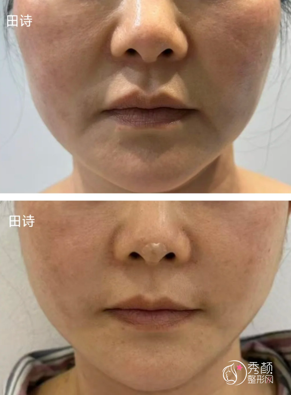 济南埋线提升医生排名：崔荣涛、张建英、郭苓玲等医生实力上榜