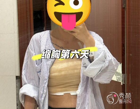 上海缩胸医生排名：黄一雄、何金光、江华等医生实力上榜