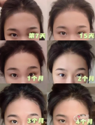 北京协和医院植发多少钱