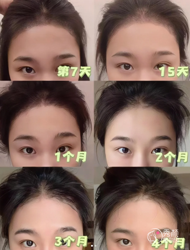 北京协和医院植发多少钱一个毛囊，哪个医生好？植发医生介绍