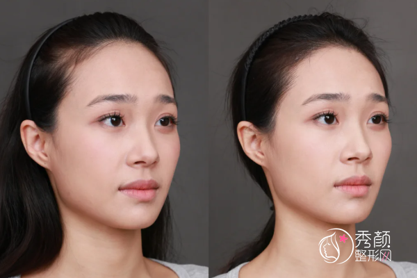 北京友谊医院植发多少钱一个毛囊，哪个医生好？植发医生介绍