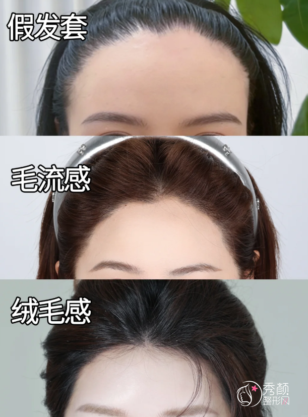 北京大学人民医院植发多少钱一个毛囊，哪个医生好？植发医生介绍