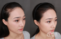 北医三院植发多少钱一个