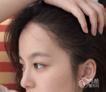 上海九院植发多少钱一个毛囊，哪个医生好？植发医生介绍