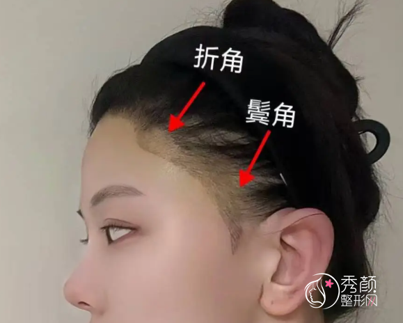 北京八大处植发多少钱一个毛囊，哪个医生好？植发医生介绍