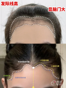 湘雅二医院植发多少钱一个毛囊，哪个医生好？植发医生介绍