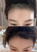 郑大一附院植发多少钱一个毛囊，哪个医生好？植发医生介绍