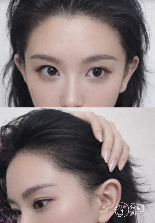 南方医院植发多少钱一个毛囊，哪个医生好？植发医生介绍