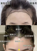 中大一院植发多少钱一个毛囊，哪个医生好？植发医生介绍