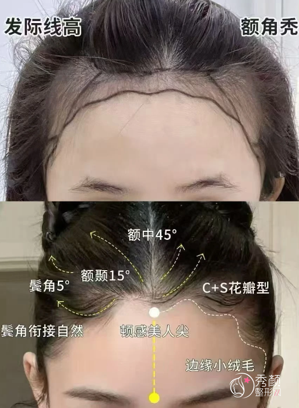 中大一院植发多少钱一个毛囊，哪个医生好？植发医生介绍