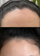 浙大一院植发多少钱一个毛囊，哪个医生好？植发医生介绍