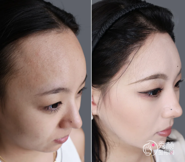 浙大二院植发多少钱一个毛囊，哪个医生好？植发医生介绍