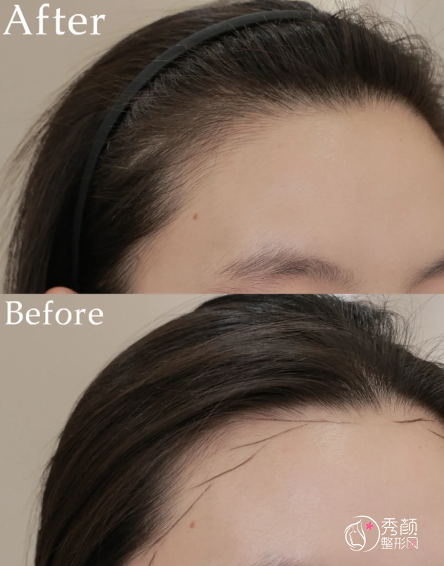 上海中山医院植发多少钱一个毛囊，哪个医生好？植发医生介绍