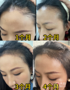 上海瑞金医院植发多少钱一个毛囊，哪个医生好？植发医生介绍