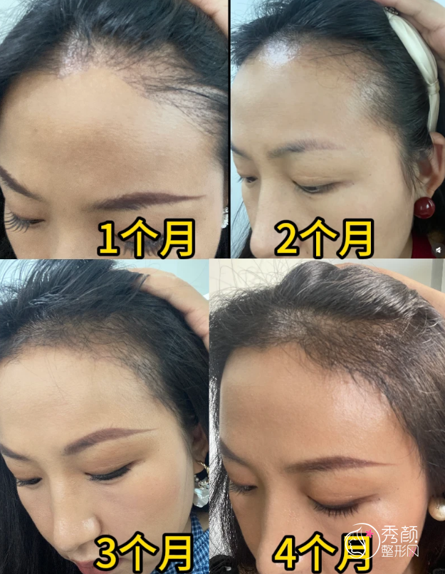 上海瑞金医院植发多少钱一个毛囊，哪个医生好？植发医生介绍