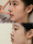 北京协和医院隆鼻多少钱？哪个医生好？隆鼻医生介绍