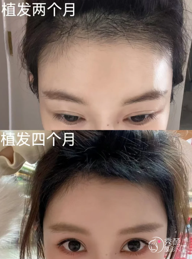 四川大学华西医院植发多少钱一个毛囊，哪个医生好？植发医生介绍