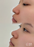 解放军总医院隆鼻多少钱？哪个医生好？隆鼻医生介绍