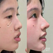 北京友谊医院隆鼻多少钱？哪个医生好？隆鼻医生介绍