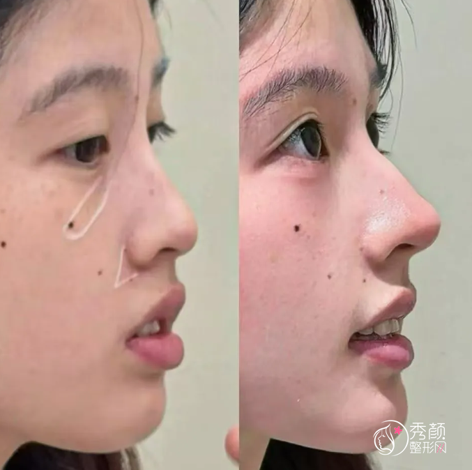 北京友谊医院隆鼻多少钱？哪个医生好？隆鼻医生介绍